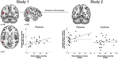 Gray Matter Alterations Associated With Dissociation in Female Survivors of Childhood Trauma